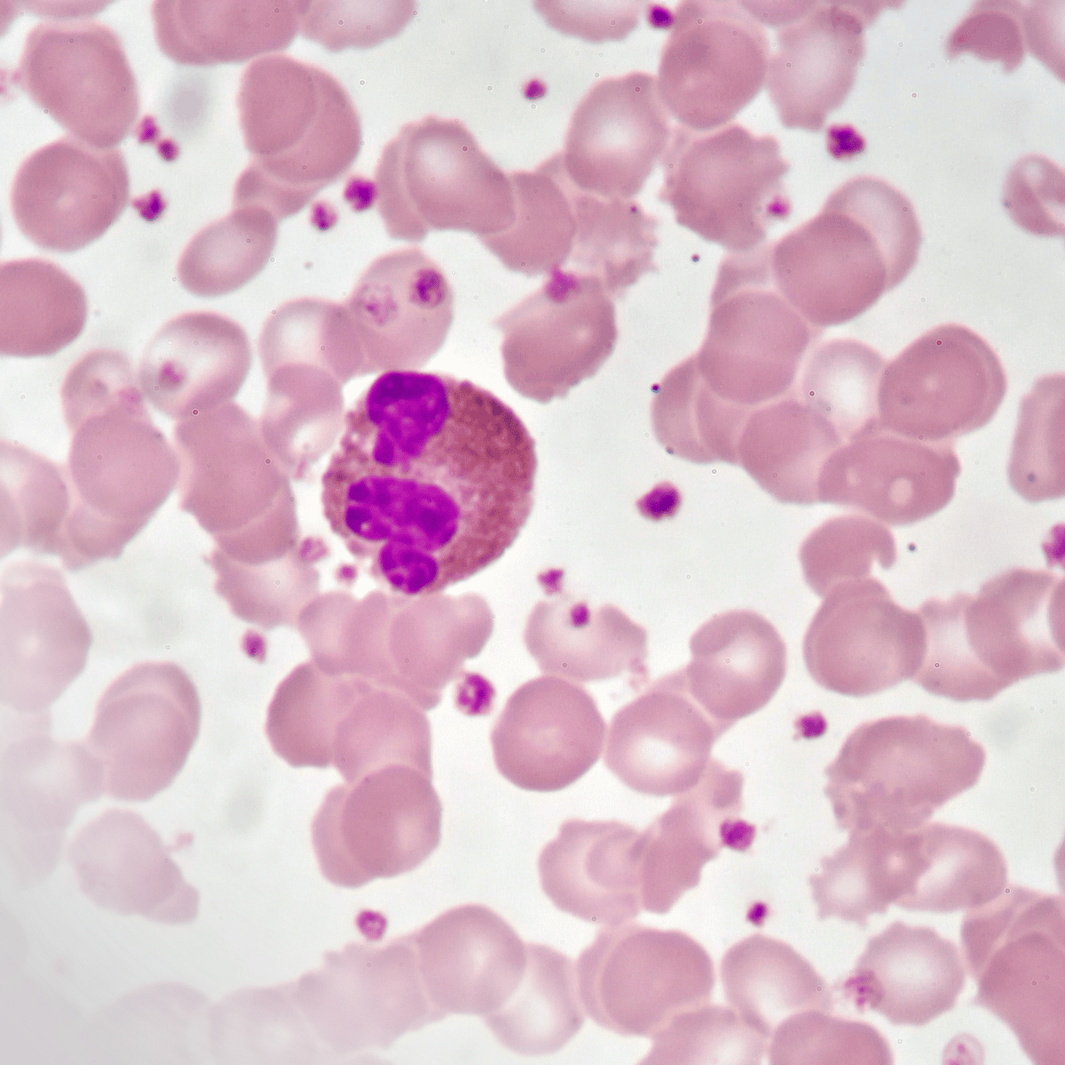 Feboesclerosis